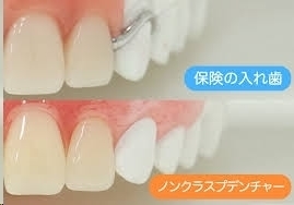 入れ歯治療の種類 - ささがわ歯科クリニック（市川市・本八幡駅）